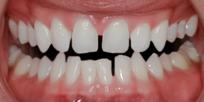 Before Invisalign®, Wes