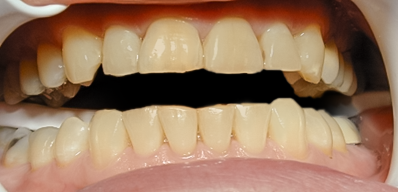 Before Zoom! 2 Tooth Whitening, Yellow Shades Tend to Respond Better