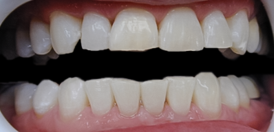 Zoom! 2 Tooth Whitening