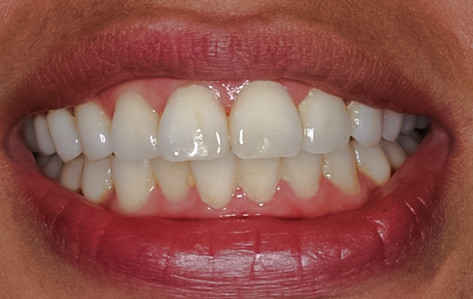 Before Zoom! 2 Tooth Whitening, Some People End Up With Dramatic Results