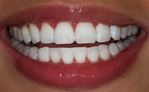 After Zoom! 2 Tooth Whitening, Some People End Up With Dramatic Results