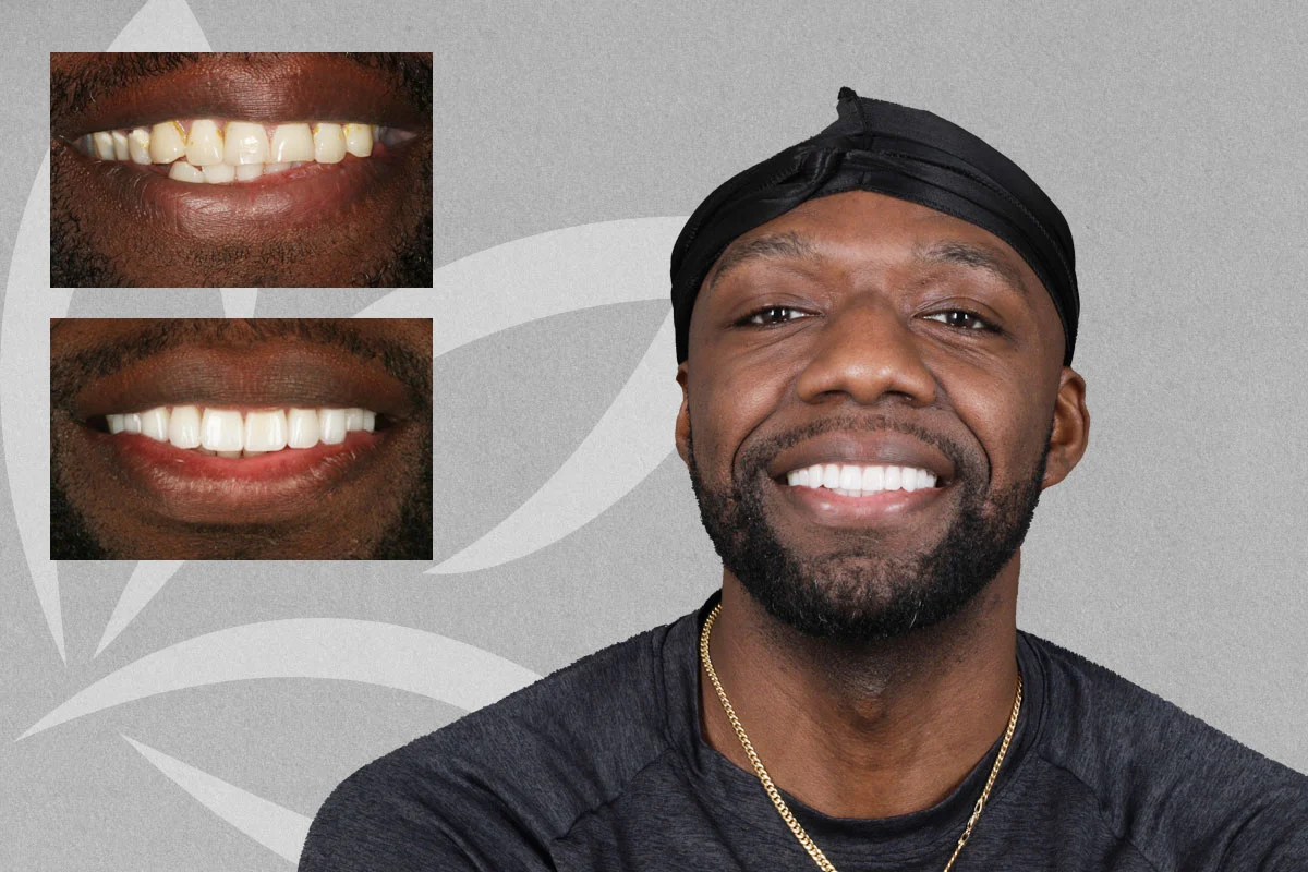 Jess, reclaimed smile after cancer treatment featured transformation