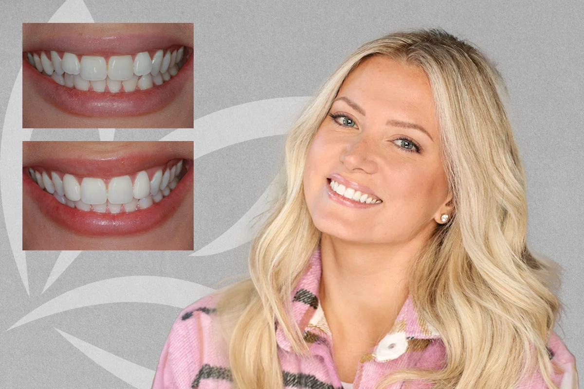 Miss Georgia smile transformation