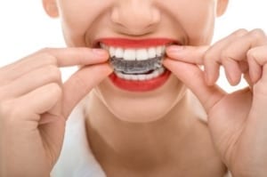 Benefit from Invisalign in Marietta