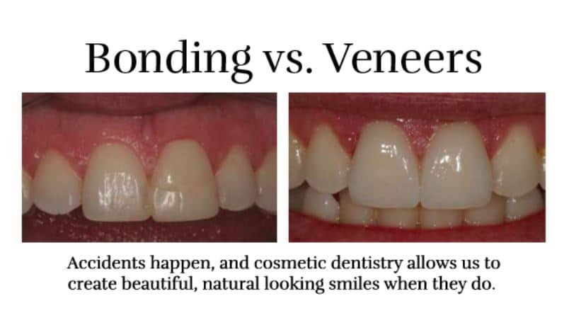 bonding vs veneers