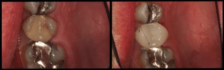 CEREC Crown Before & After