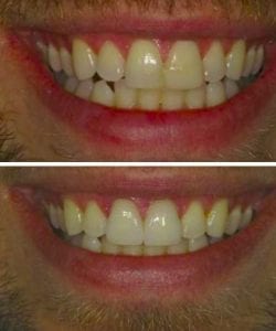 Porcelain Veneers Treatment Marietta