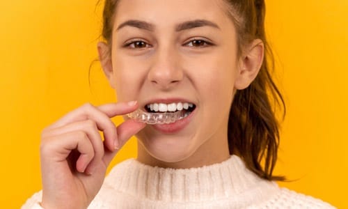 invisalign aligners use button attachments for crowded teeth