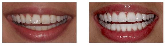 before and after teeth whitening treatment