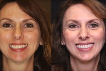 Marietta Invisalign Case Study