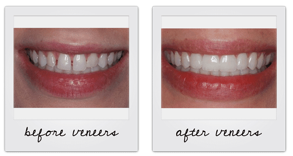 before and after veneers