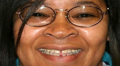 Cosmetic Dentist Partial Dentures After