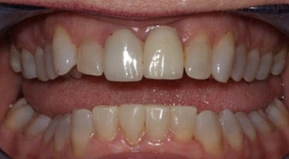 Cosmetic Dentist Inman Aligner After