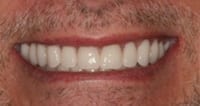 smile makeover example