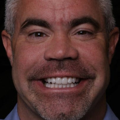 Cosmetic Dentist Veneers After