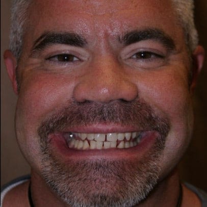 Cosmetic Dentist Veneers Before
