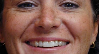 Cosmetic Dentist Teeth Whitening Zoom Before