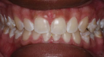 after Invisalign treatment
