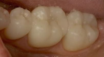 tooth color fillings after