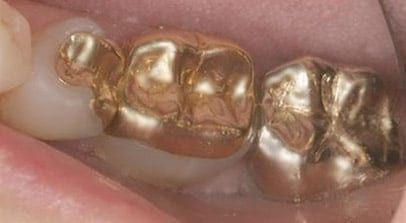tooth color fillings before