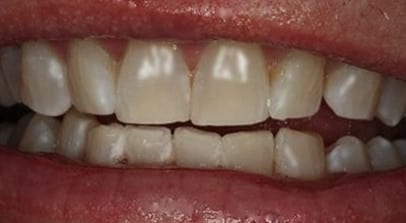whitening after