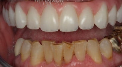 Ron after Teeth-In-A-Day