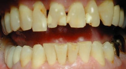 Ron before Teeth-In-A-Day