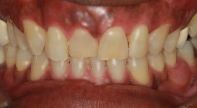 Before Heighten Veneers