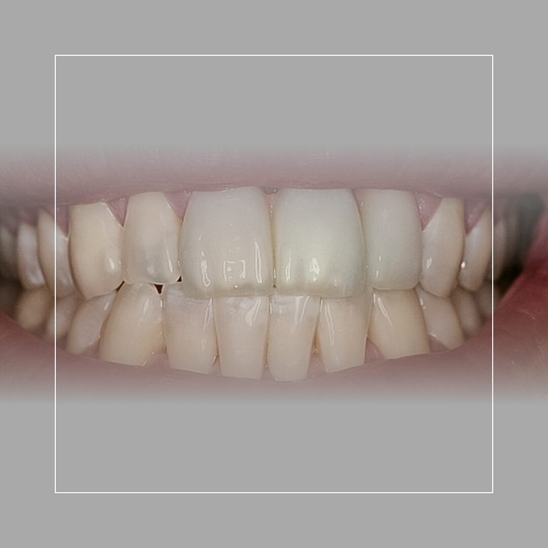Anterior Three-Unit Bridge – A Seamless Solution for Tooth Loss – A Complete Transformation with Multiple Veneers