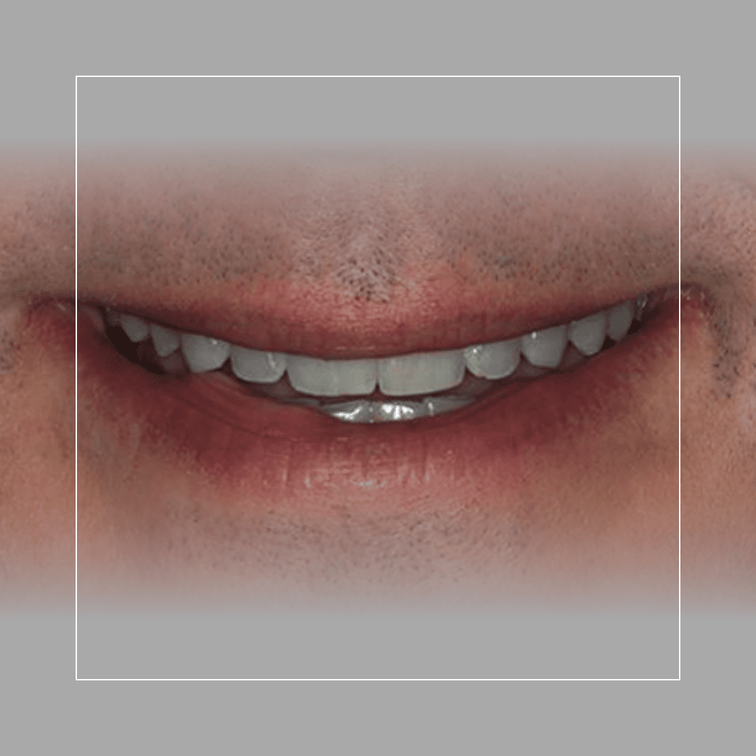 David – A Straighter Smile with Invisalign