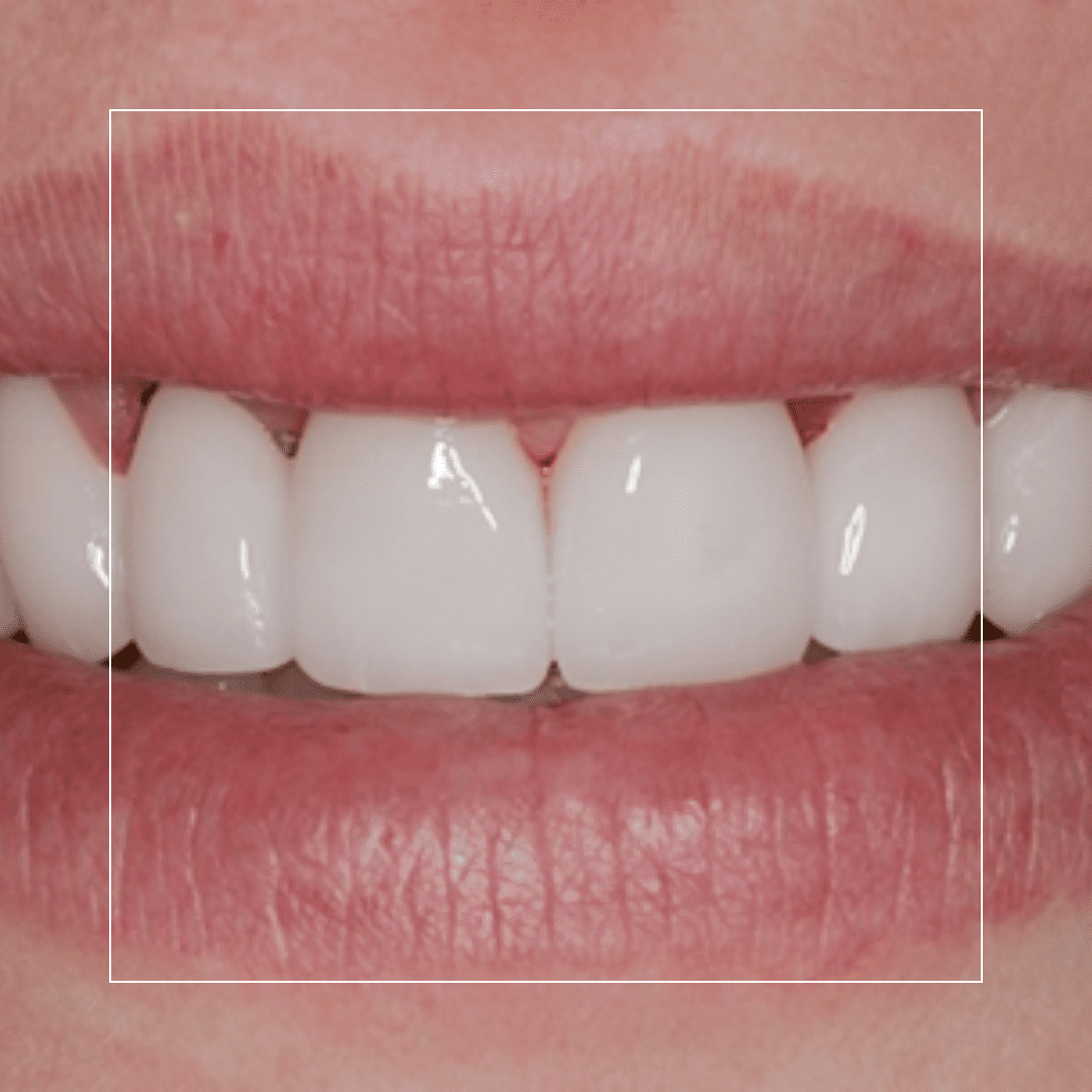 Eight Upper Veneers for Crooked Teeth – A Straighter Smile Without Braces