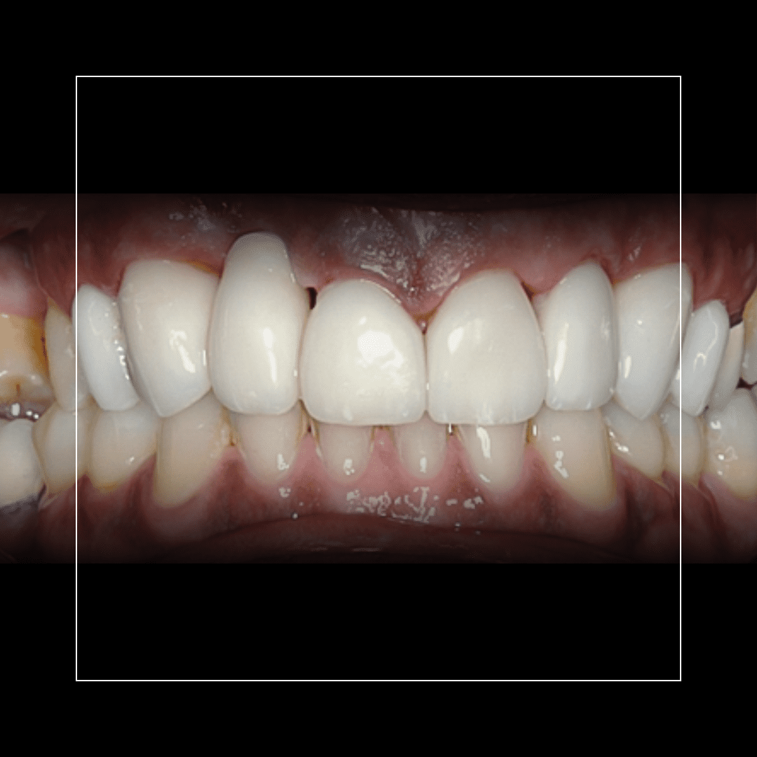 Eight Upper Veneers to Heighten Teeth – Enhancing Proportion and Elegance