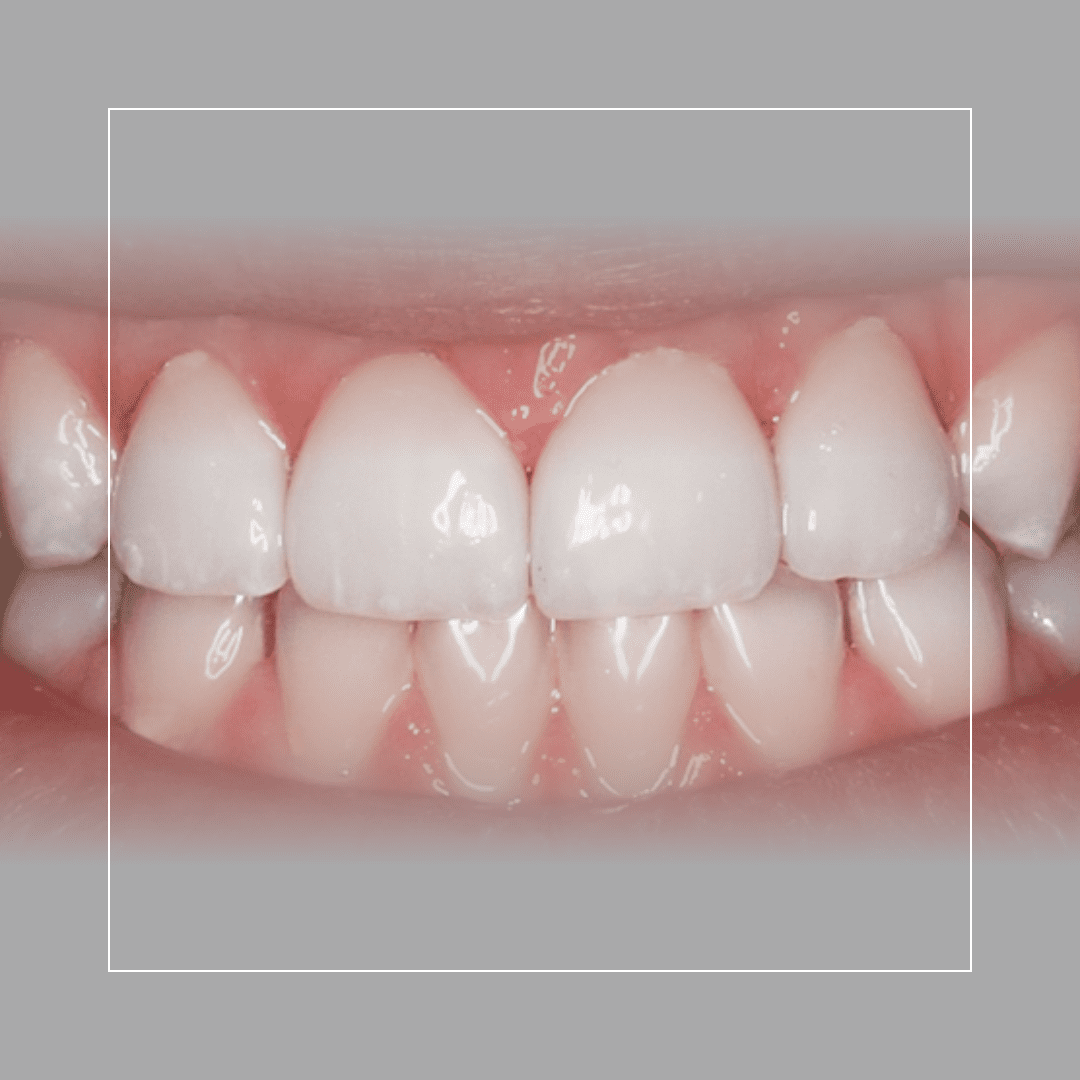 Four Upper Veneers to Close Gap and Even Front Teeth – A Simple Fix for a Noticeable Difference
