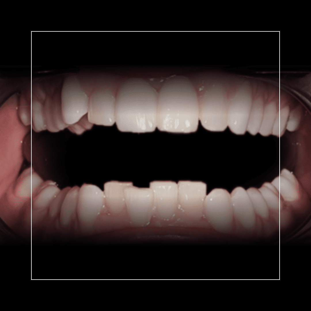 Inman Aligner – A Simple Solution for a Lifelong Concern