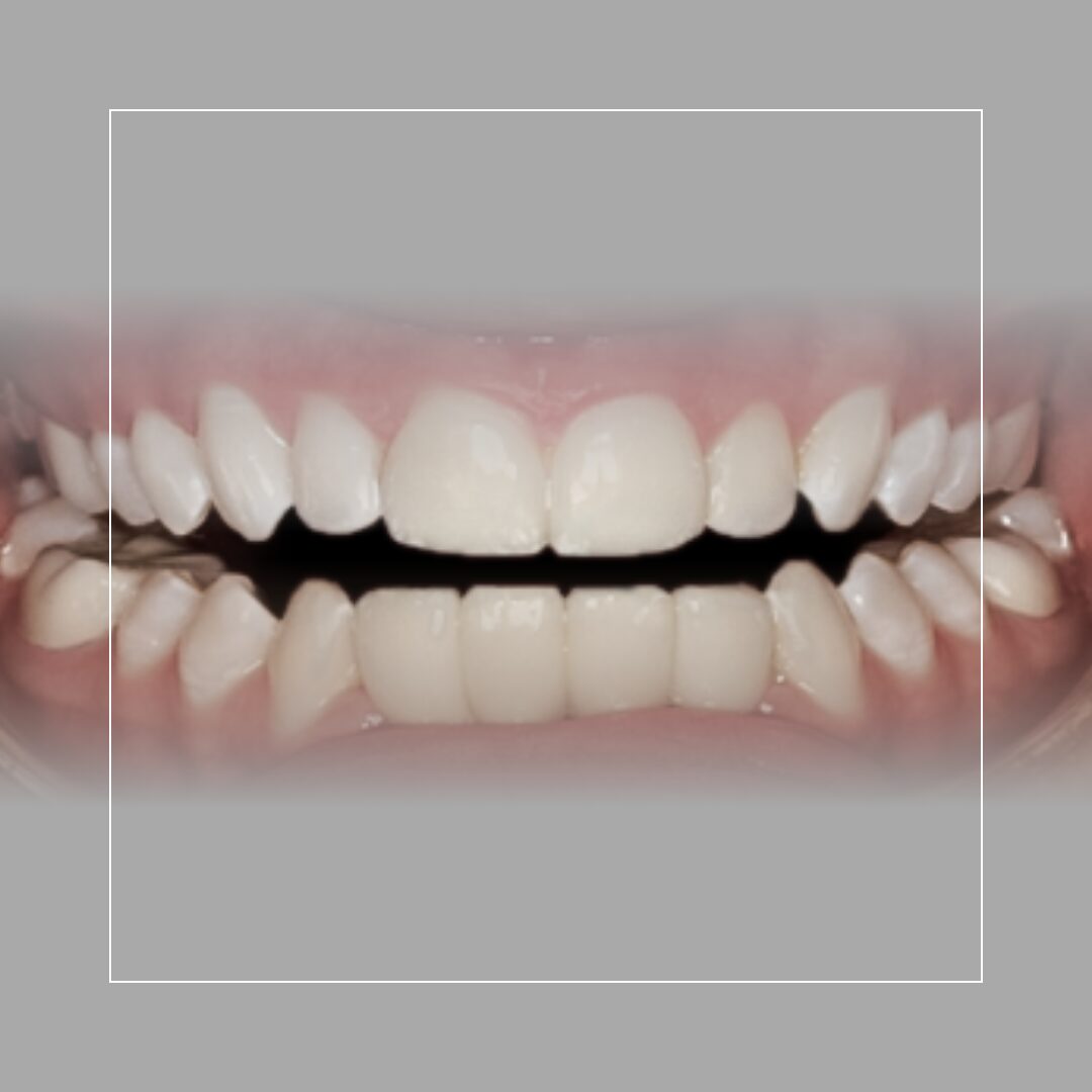 Lower Anterior Implant Bridge – Restoring Form and Function Three-Unit Bridge – A Seamless Solution for Tooth Loss – A Complete Transformation with Multiple Veneers