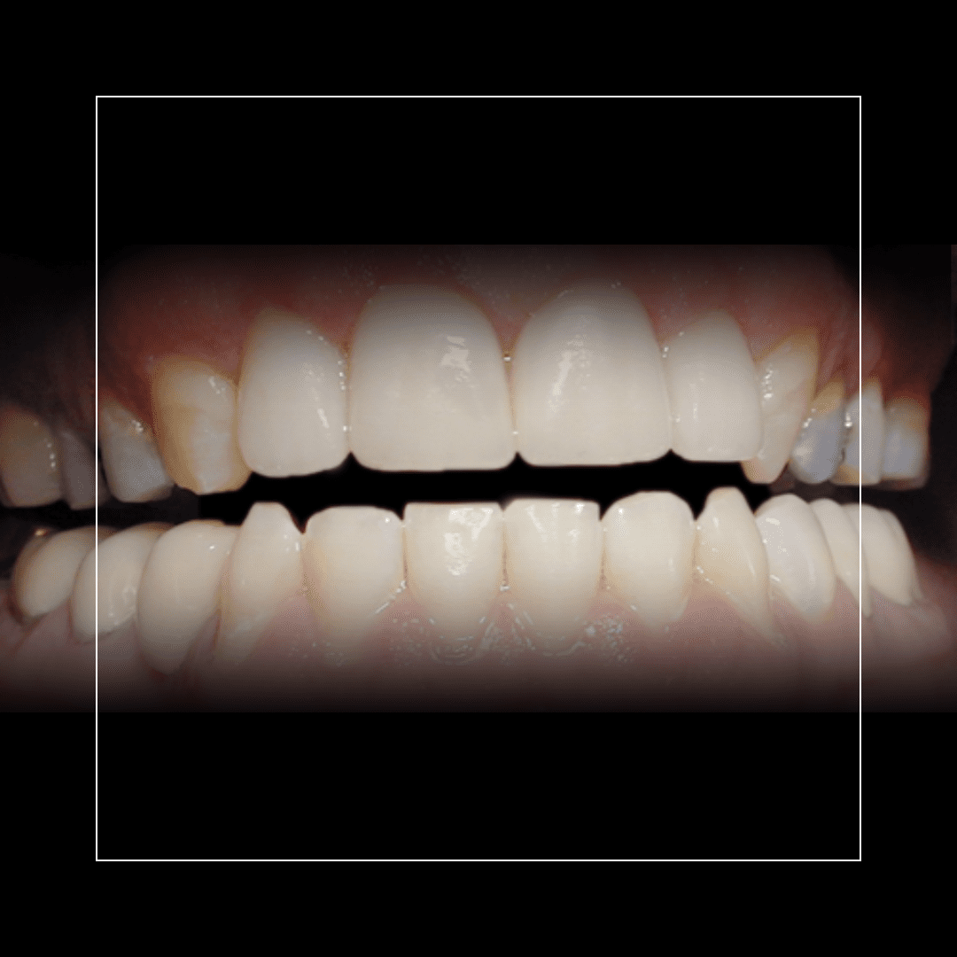 Mary – Four Conservative Crowns for a Stronger Smile