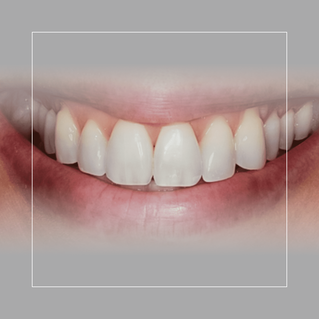 Premolar Veneers – No Prep for a Conservative Approach