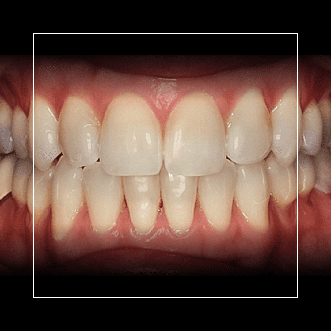 Rebecca – Invisalign for a Balanced and Even Smile