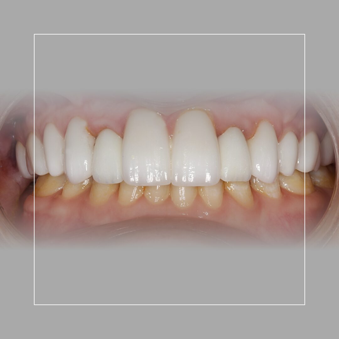 Smile Makeover – Allie