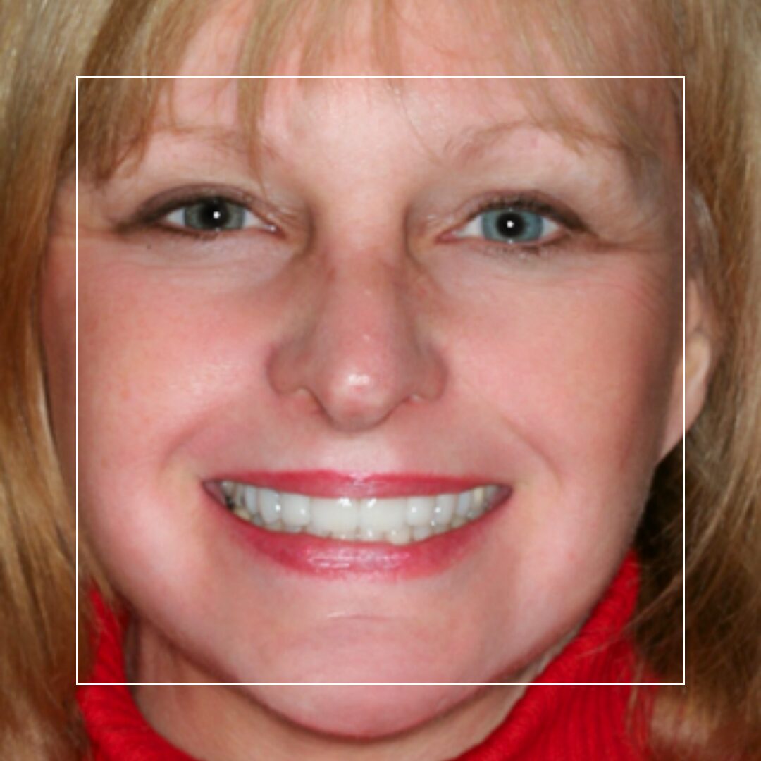 Smile Makeover – Diane