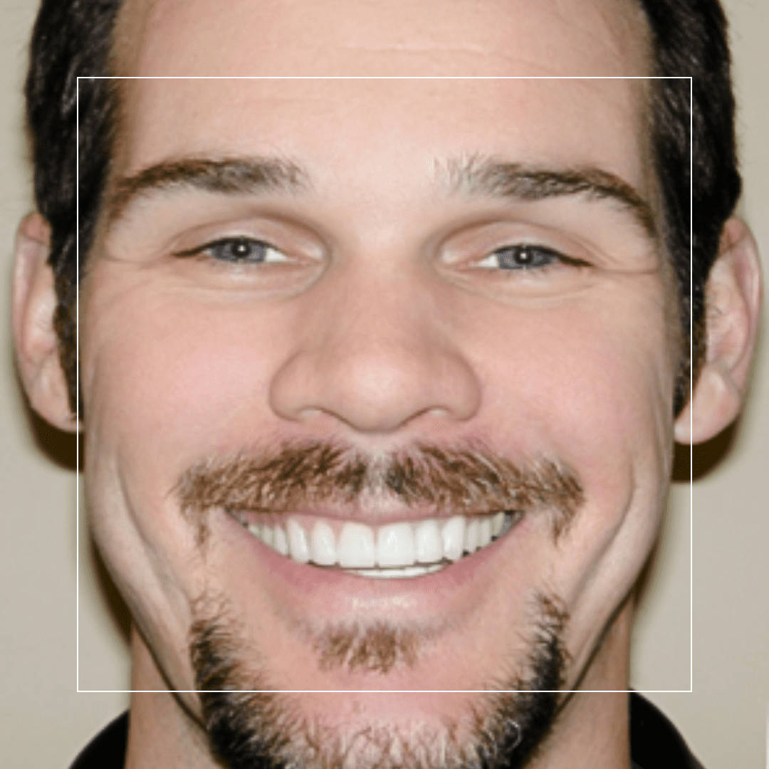 Smile Makeover – Greg