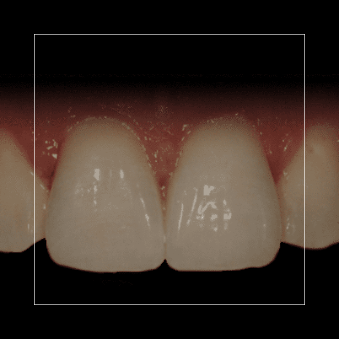 Smile Makeover – Jason