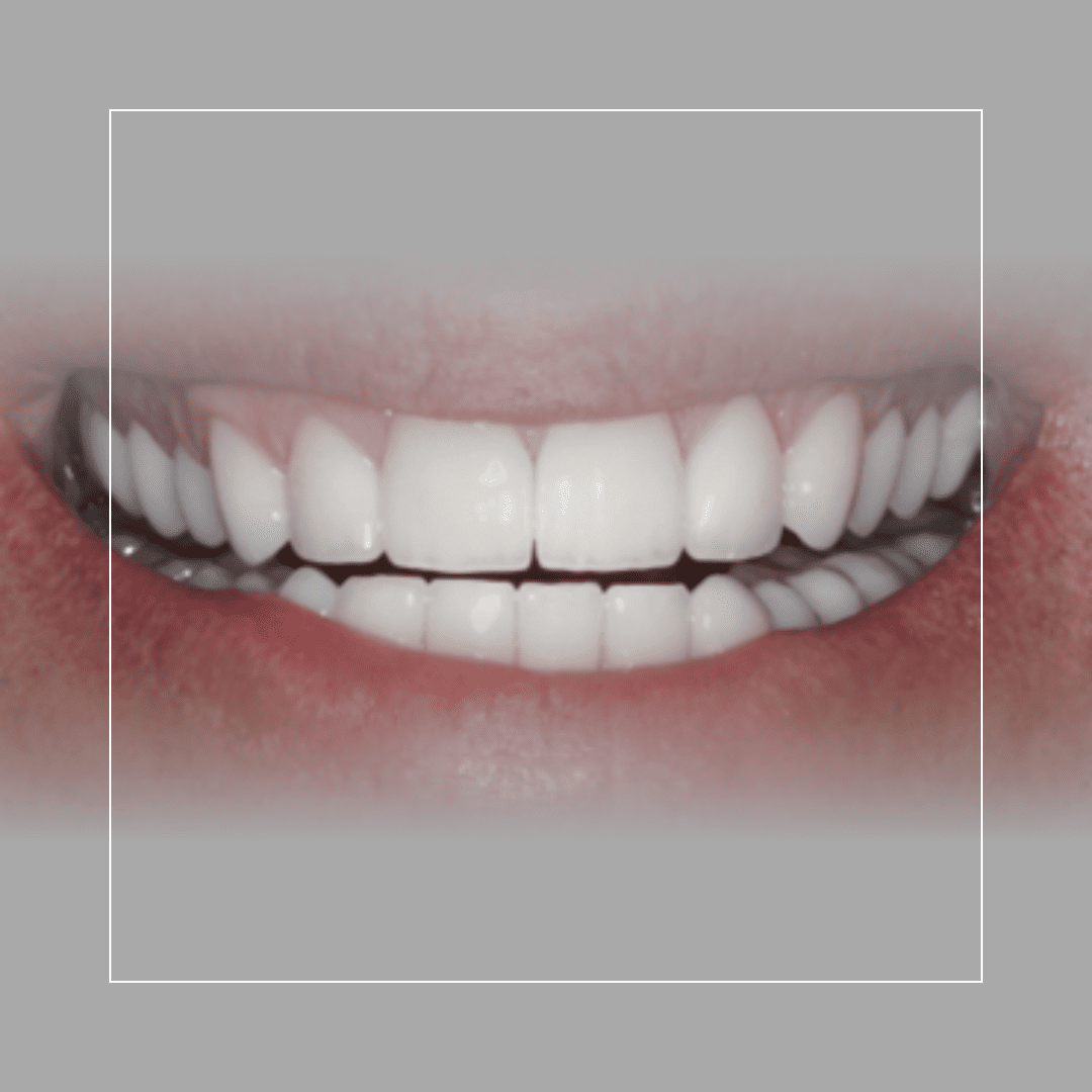 Smile Makeover for Acid Erosion