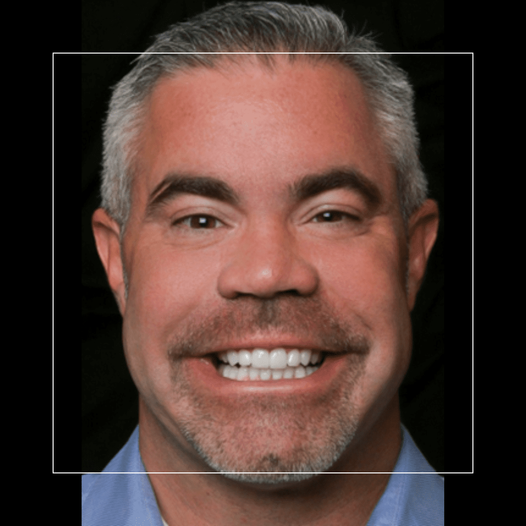 Smile Makeover to Close Spaces