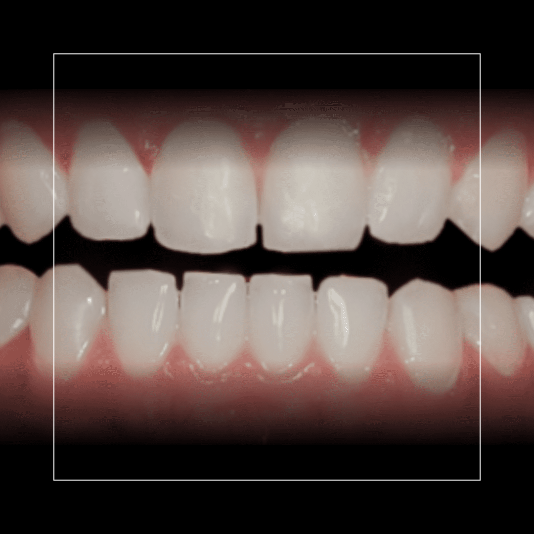 Tamara – A Clear Path to a Straighter Smile