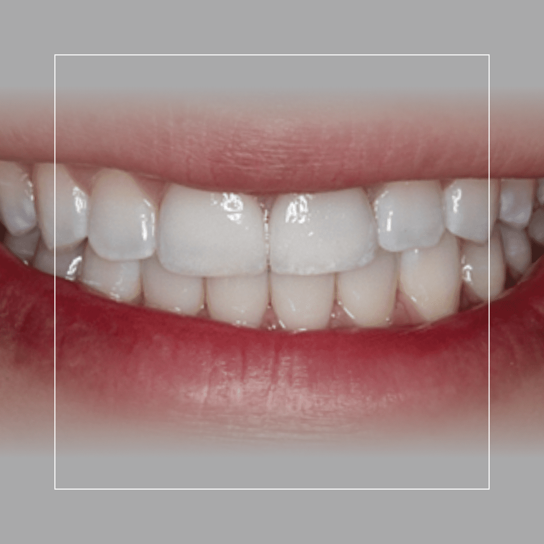 Two Anterior Veneers for Broken Teeth – Restoring Strength and Beauty