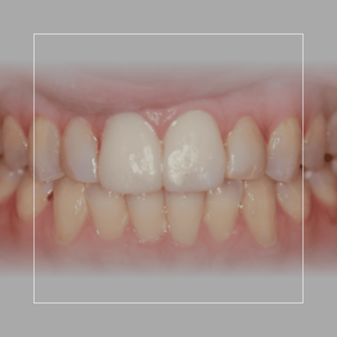 Two Central Veneers to Treat Two Chipped Front Teeth