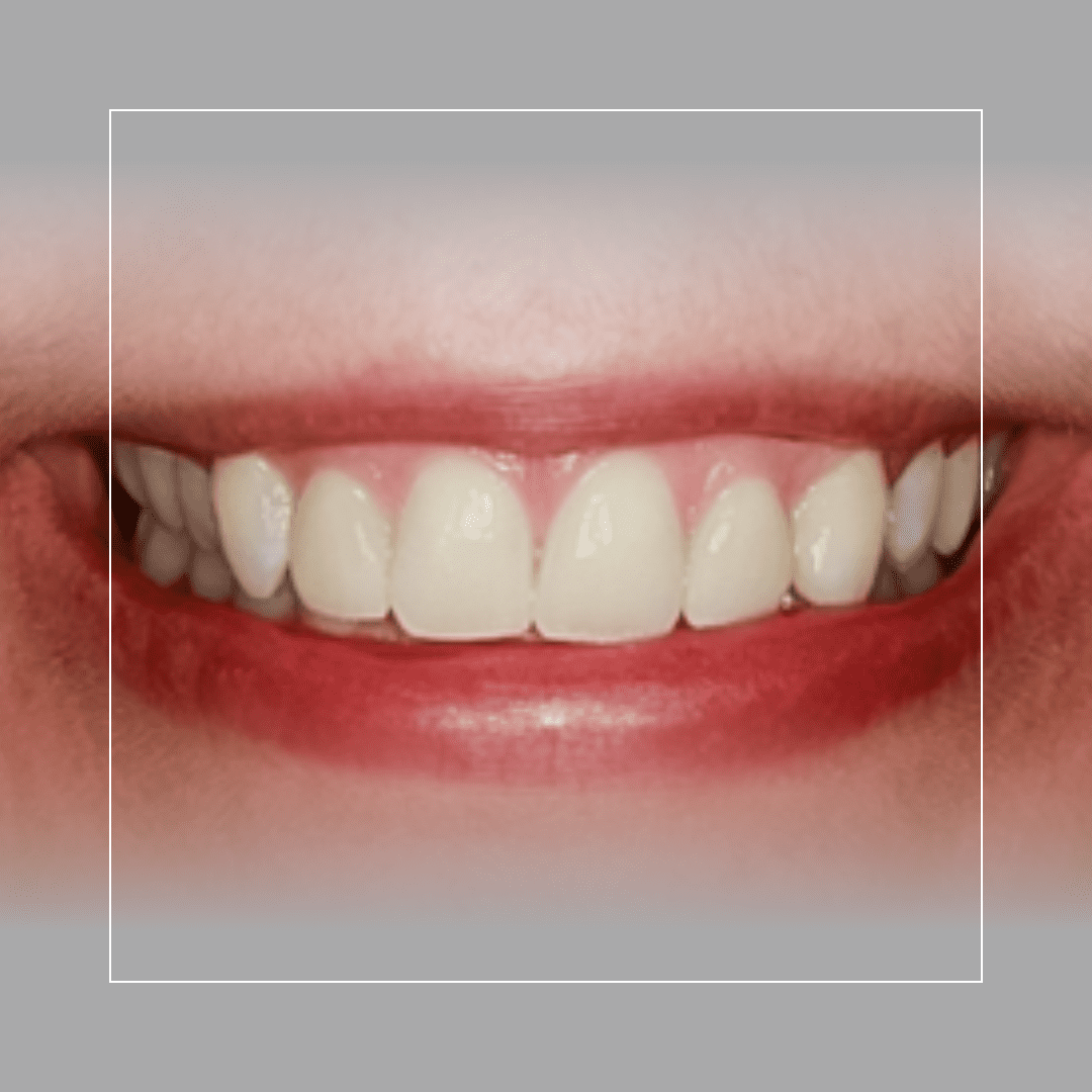 Two Lateral Incisor Veneers – No Prep for a Natural Look