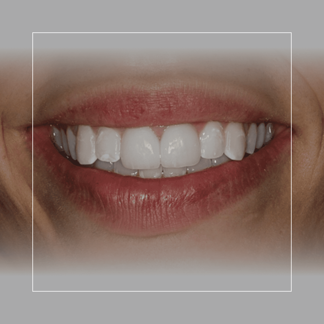 Two Veneers to Replace Old Bonding – A More Durable, Lifelike Upgrade
