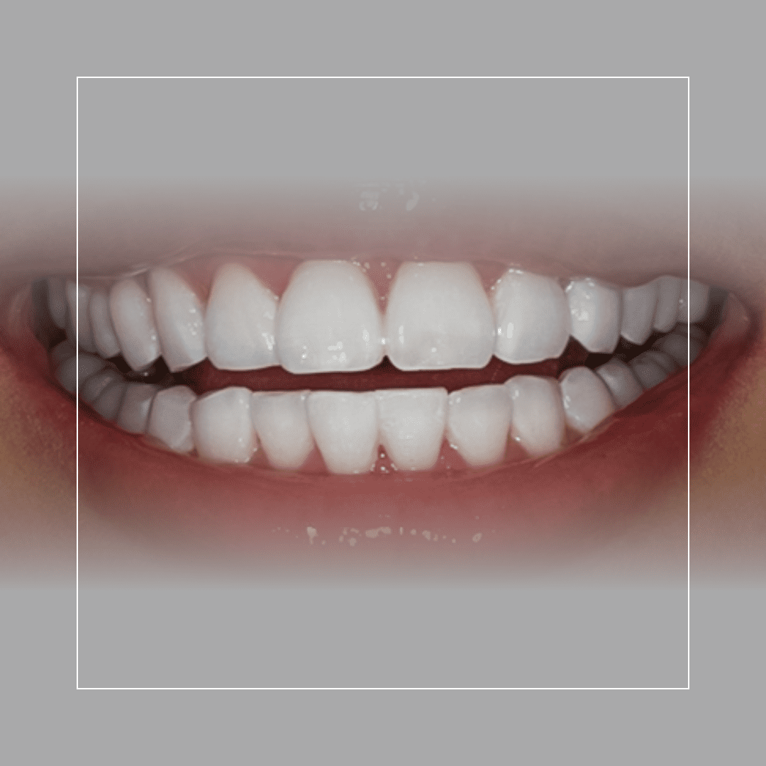 Zoom! 2 Tooth Whitening – Dramatic Results